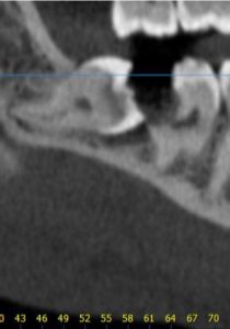 CT Dent  Capture 7  