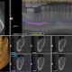 CT Dent Case of the month - Implant Planning in the UR5