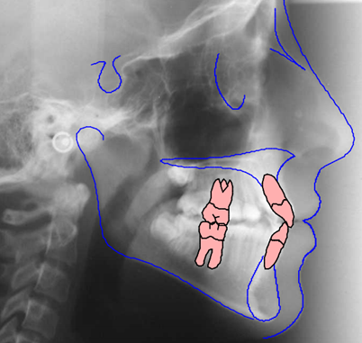 cephalometric-ceph-tracing-ctdent