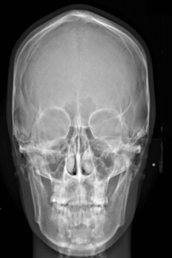 PA Digital Cephalometric PA Digital Cephalometric