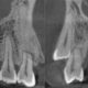 CT Dent Case of the Month - All-on-Four and Zygomatic Implant Planning