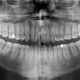 CT Dent Case of the Month - The Relationship of the Lower Third Molars with the Mandibular Canal