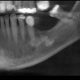CT Dent Case of the month - Implant Planning