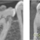 CT Dent Case of the Month - Large cyst anterior mandible