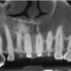 CT Dent Case of the Month - Invasive Cervical Resorption