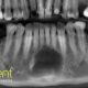 CT Dent Case of the month - Identifying expended lesion