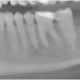 CT Dent Case of the Month - Large cyst anterior mandible