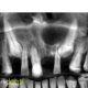 CT Dent Case of the month - Identifying expended lesion