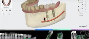 CT Dent  DTS_dental_laboratory_glasgow_scotland_uk_digital_scanning_implant_studio  
