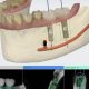 CT Dent The Rising Popularity of Dental CT Scans: A Revolutionary Diagnostic Tool